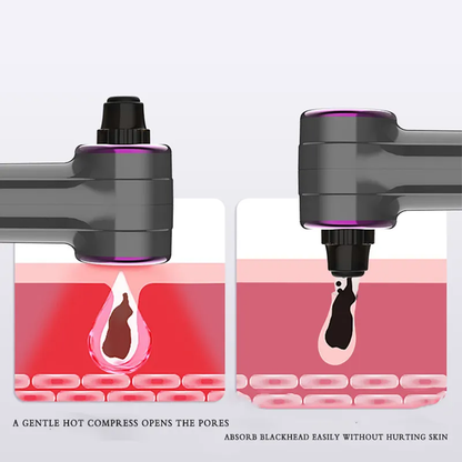Aparat de Indepartat Puncte Negre, cu Vacuum SINZO®, 5 tipuri de cap de aspiratie, 3 programe de aspirare, 3 moduri de reglare a vitezei, incarcare USB